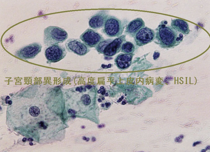 子宮頸部異形成(高度扁平上皮内病変、HSIL)子宮頸部擦過細胞診 子宮頸部異形成(高度扁平上皮内病変、HSIL)子宮頸部擦過細胞診