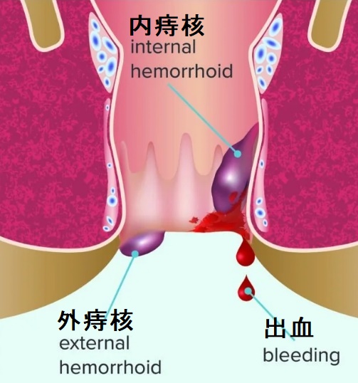 痔核と甲状腺 痔核と甲状腺