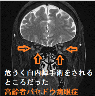 危うく眼科で白内障手術をされるところだった活動性甲状腺眼症・バセドウ病眼症(74歳女性)1 危うく眼科で白内障手術をされるところだった活動性甲状腺眼症・バセドウ病眼症(74歳女性)1