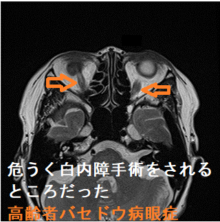 危うく眼科で白内障手術をされるところだった活動性甲状腺眼症・バセドウ病眼症(74歳女性)2 危うく眼科で白内障手術をされるところだった甲状腺眼症・バセドウ病眼症(74歳女性)2