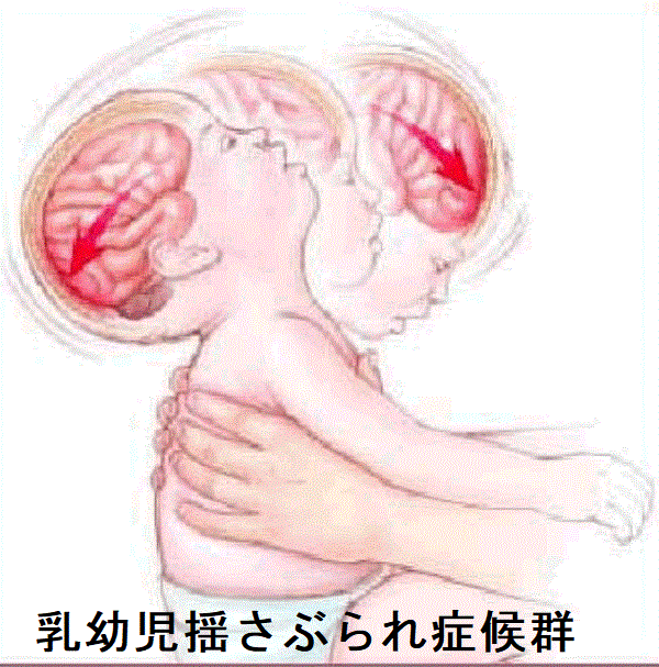 乳幼児揺さぶられ症候群 乳幼児揺さぶられ症候群