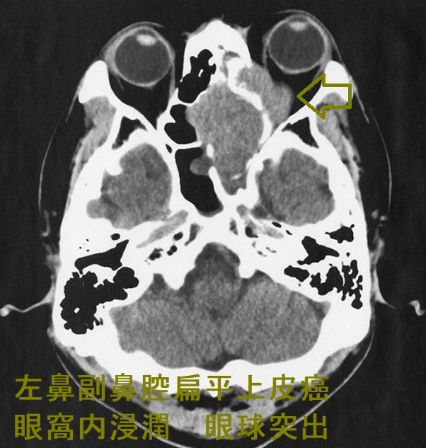 左鼻副鼻腔扁平上皮癌 眼窩内浸潤 眼球突出 造影CT画像 左鼻副鼻腔扁平上皮癌 眼窩内浸潤 眼球突出 造影CT画像