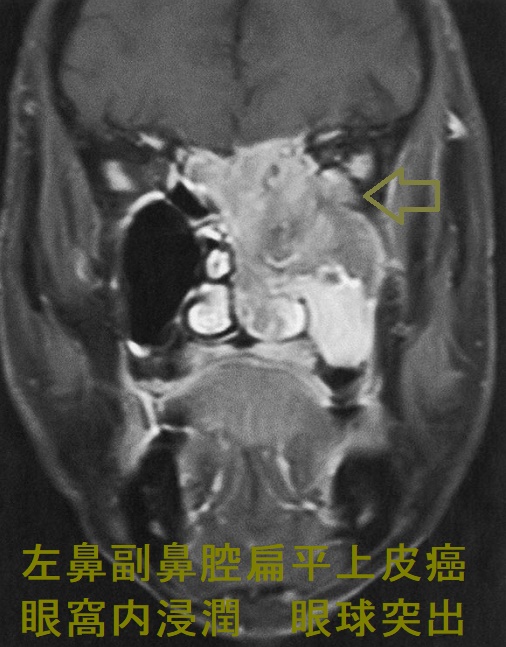 左鼻副鼻腔扁平上皮癌 眼窩内浸潤 眼球突出 MRI 脂肪抑制造影Ti強調画像 左鼻副鼻腔扁平上皮癌 眼窩内浸潤 眼球突出 MRI 脂肪抑制造影Ti強調画像