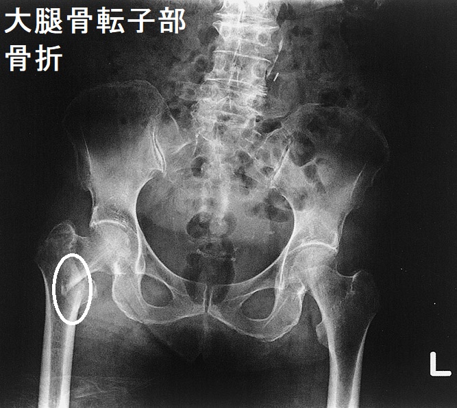 大腿骨転子部骨折 大腿骨転子部骨折