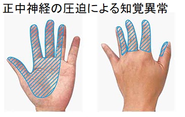 正中神経の圧迫による知覚異常 正中神経の圧迫による知覚異常