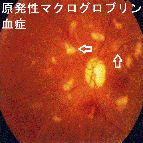 原発性マクログロブリン血症 眼底 原発性マクログロブリン血症 眼底