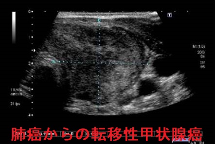 肺癌からの転移性甲状腺癌 肺癌からの転移性甲状腺癌