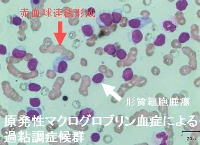 原発性マクログロブリン血症 原発性マクログロブリン血症