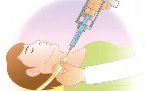 甲状腺穿刺吸引細胞診 甲状腺穿刺吸引細胞診