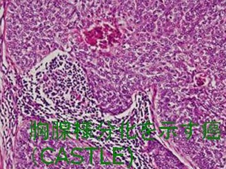 胸腺様分化を示す癌(CASTLE) 組織 胸腺様分化を示す癌(CASTLE) 組織2