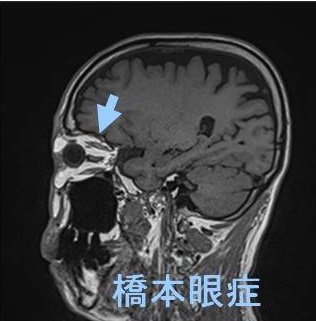 橋本病眼症 MRI画像 橋本病眼症 MRI画像