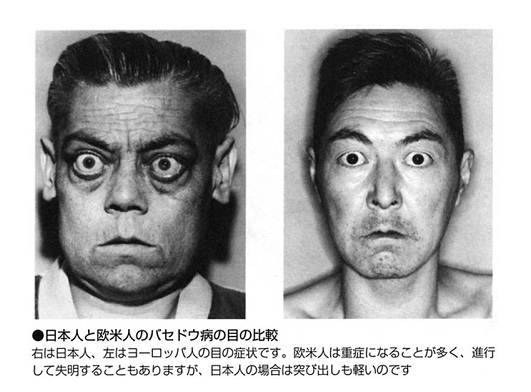バセドウ病 