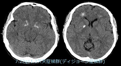 甲状腺と胸腺腫/重症筋無力症・CASTLE甲状腺癌