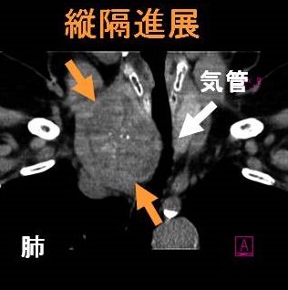 甲状腺腫瘍 縦隔進展(気管圧排) 甲状腺腫瘍 縦隔進展(気管圧排)