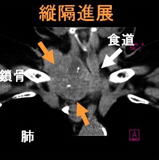 縦隔内甲状腺腫[橋本病 バセドウ病 甲状腺超音波検査エコー