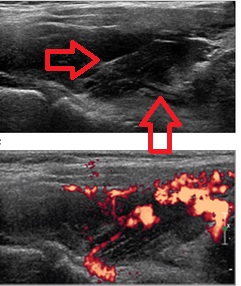 甲状腺血管腫 甲状腺血管腫