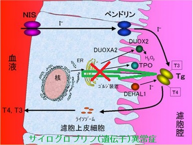 サイログロブリン(遺伝子)異常症 サイログロブリン(遺伝子)異常症