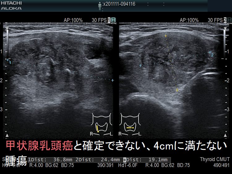 甲状腺乳頭癌と確定できない、4cmに満たない腫瘍 超音波(エコー)画像 甲状腺乳頭癌と確定できない、4cmに満たない腫瘍 超音波(エコー)画像
