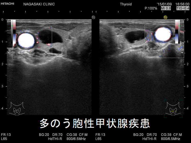 多のう胞性甲状腺疾患 超音波(エコー)画像 多のう胞性甲状腺疾患 超音波(エコー)画像2