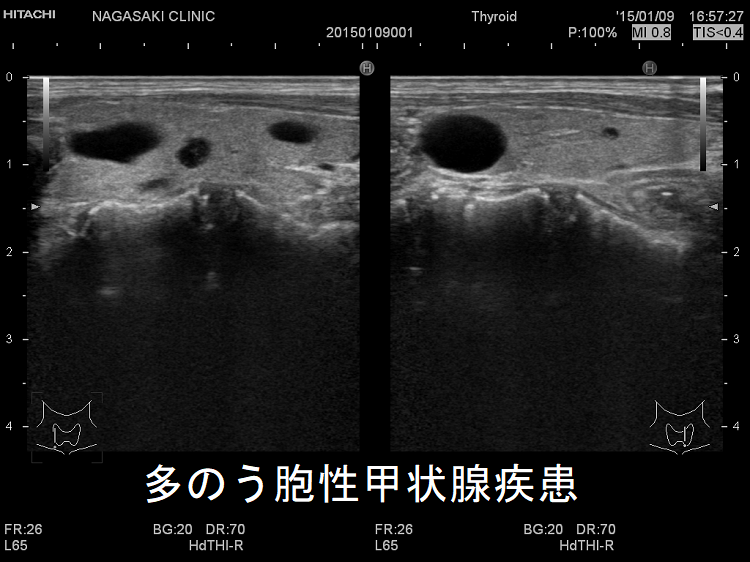 多のう胞性甲状腺疾患 超音波(エコー)画像 多のう胞性甲状腺疾患 超音波(エコー)画像