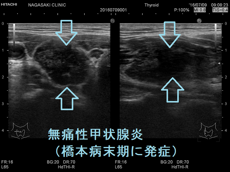 無痛性甲状腺炎(橋本病末期に発症) 無痛性甲状腺炎(橋本病末期に発症)