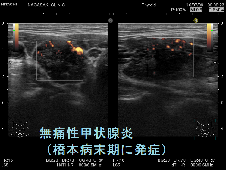 無痛性甲状腺炎(橋本病末期に発症)ドプラー 無痛性甲状腺炎(橋本病末期に発症)ドプラー