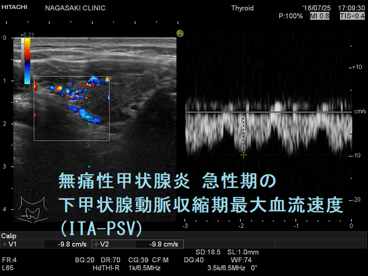 無痛性甲状腺炎とバセドウ病との鑑別[橋本病 超音波エコー