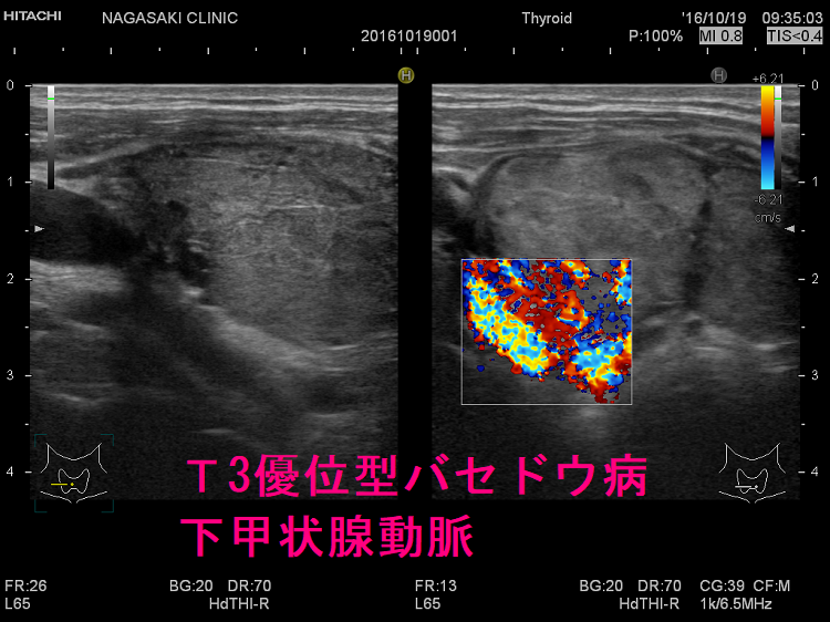 T3優位型バセドウ病 超音波(エコー)画像 下甲状腺動脈 T3優位型バセドウ病 超音波(エコー)画像 下甲状腺動脈