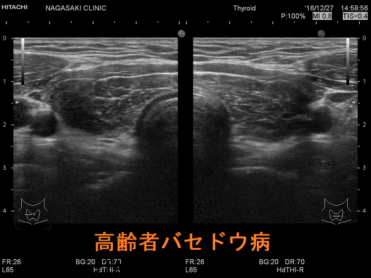 高齢者バセドウ病 超音波(エコー)画像 高齢者バセドウ病 超音波(エコー)画像