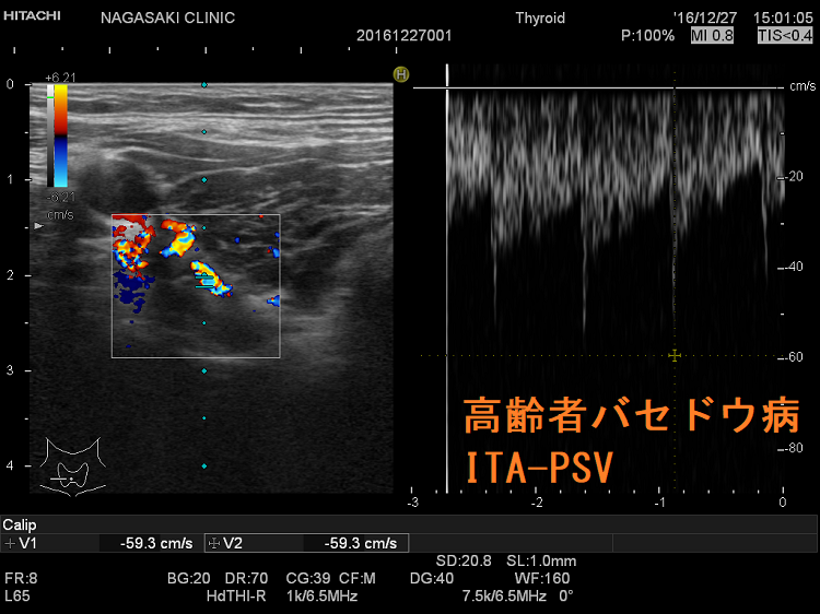 高齢者バセドウ病 超音波(エコー)画像 ITA-PSV 高齢者バセドウ病 超音波(エコー)画像 ITA-PSV