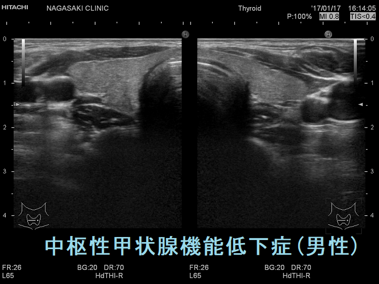 中枢性甲状腺機能低下症(男性) 超音波(エコー)画像 中枢性甲状腺機能低下症(男性) 超音波(エコー)画像