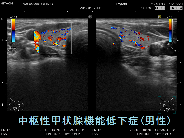 中枢性甲状腺機能低下症(男性) 超音波(エコー)画像(ドプラーモード) 中枢性甲状腺機能低下症(男性) 超音波(エコー)画像(ドプラーモード)