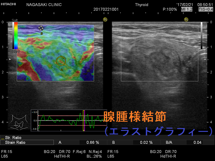 腺腫様結節(エラストグラフィー) 腺腫様結節(エラストグラフィー)