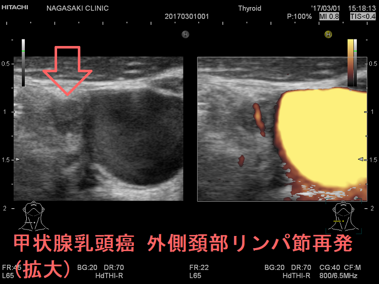 甲状腺乳頭癌 外側頚部リンパ節再発 超音波(エコー)画像 (拡大) 甲状腺乳頭癌 外側頚部リンパ節再発 超音波(エコー)画像 (拡大)