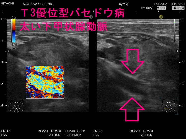 T3優位型バセドウ病太い下甲状腺動脈 T3優位型バセドウ病太い下甲状腺動脈