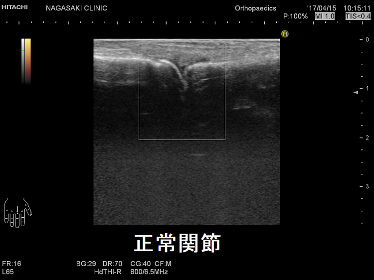 関節超音波(エコー)検査 正常関節 関節超音波(エコー)検査 正常関節