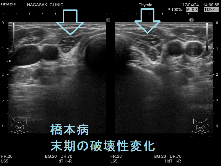 橋本病末期の破壊性変化 超音波(エコー)画像 橋本病末期の破壊性変化
