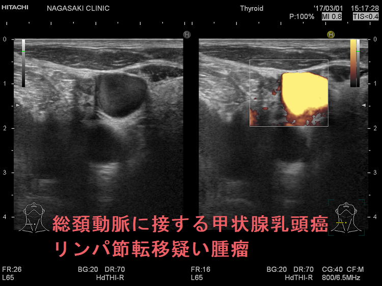 総頚動脈に接する甲状腺乳頭癌リンパ節転移疑い腫瘤 総頚動脈に接する甲状腺乳頭癌リンパ節転移疑い腫瘤