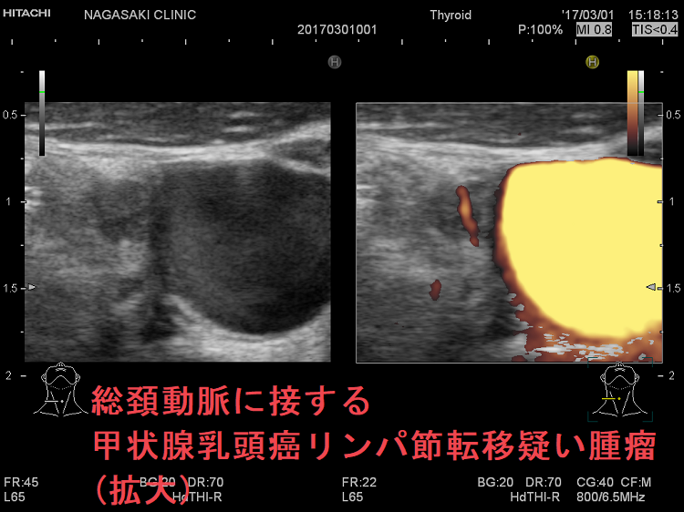 総頚動脈に接する甲状腺乳頭癌リンパ節転移疑い腫瘤(拡大) 総頚動脈に接する甲状腺乳頭癌リンパ節転移疑い腫瘤(拡大)