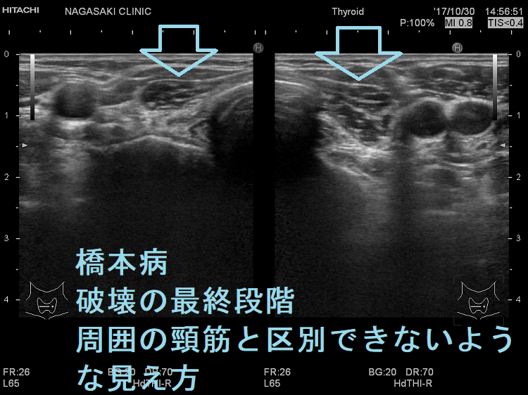 橋本病(慢性甲状腺炎):破壊の最終段階 周囲の頸筋と区別できないような見え方 橋本病(慢性甲状腺炎):破壊の最終段階 周囲の頸筋と区別できないような見え方