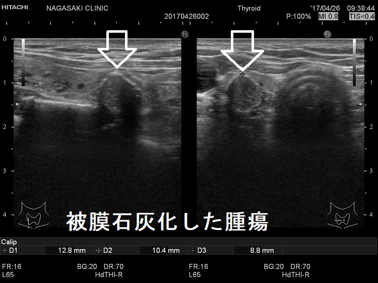 被膜石灰化した腫瘍 超音波(エコー)画像 被膜石灰化した腫瘍 超音波(エコー)画像
