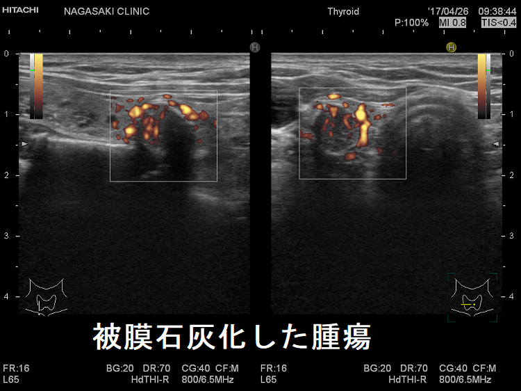 被膜石灰化した腫瘍 超音波(エコー)画像ドプラー 被膜石灰化した腫瘍 超音波(エコー)画像ドプラー