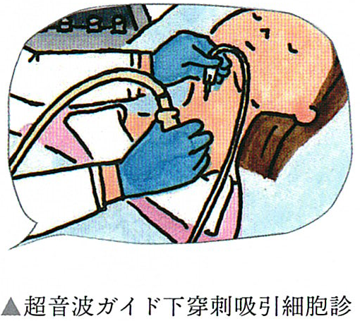 超音波ガイド下穿刺細胞診の気を付ける点 超音波ガイド下穿刺細胞診の気を付ける点