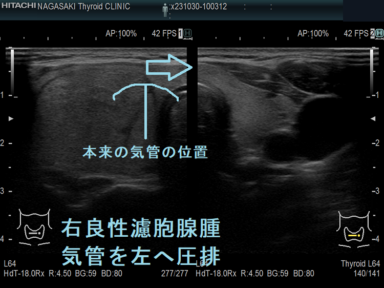 右良性濾胞腺腫 気管を左へ圧排 右良性濾胞腺腫 気管を左へ圧排