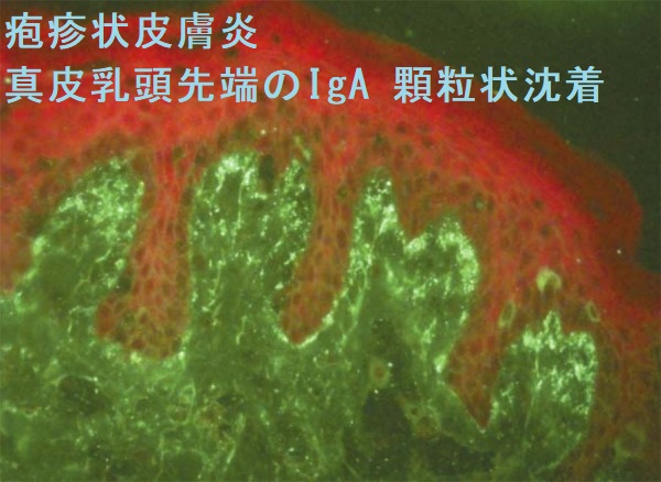 疱疹状皮膚炎 真皮乳頭先端のIgA 顆粒状沈着 疱疹状皮膚炎 真皮乳頭先端のIgA 顆粒状沈着