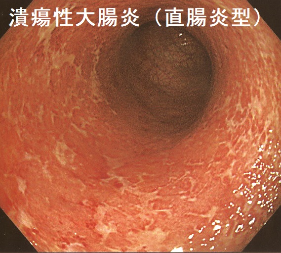 潰瘍性大腸炎(直腸炎型) 潰瘍性大腸炎(直腸炎型)
