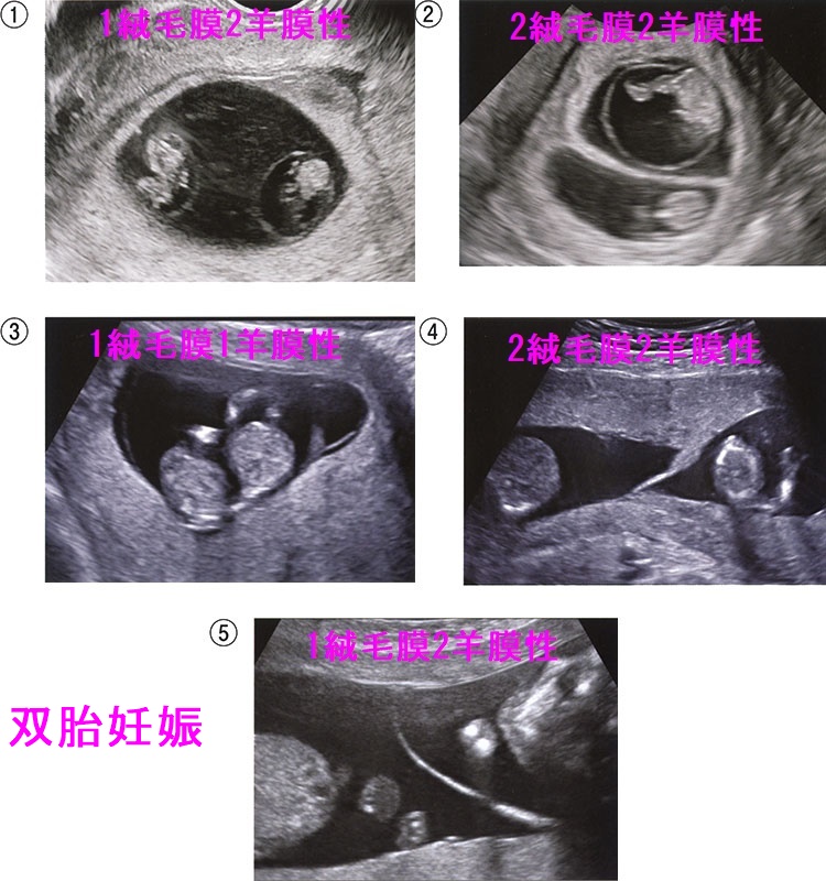 双胎妊娠 双胎妊娠