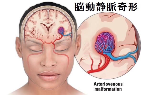 脳動静脈奇形2 脳動静脈奇形2