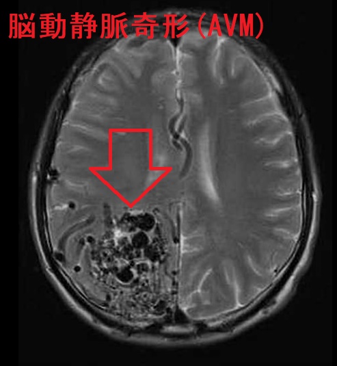 甲状腺機能亢進症/バセドウ病と頭痛,可逆性脳血管攣縮症候群,脳
