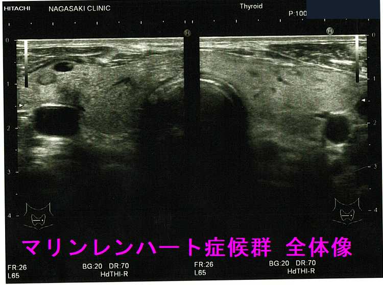 甲状腺乳頭癌を含む腺腫様結節、マリンレンハート症候群 全体像 甲状腺乳頭癌を含む腺腫様結節、マリンレンハート症候群 全体像